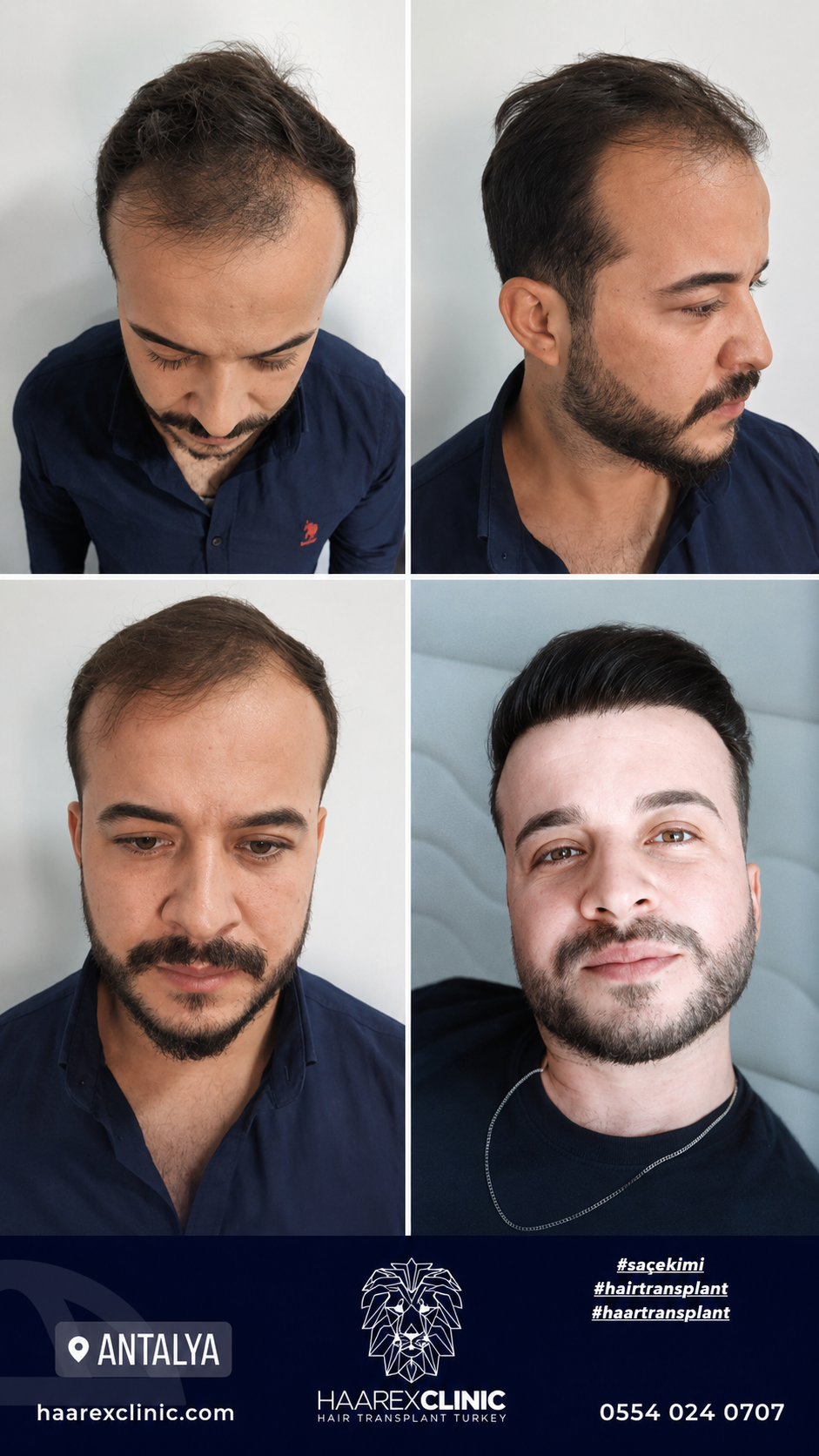 Before After Hair Transplant Result 2