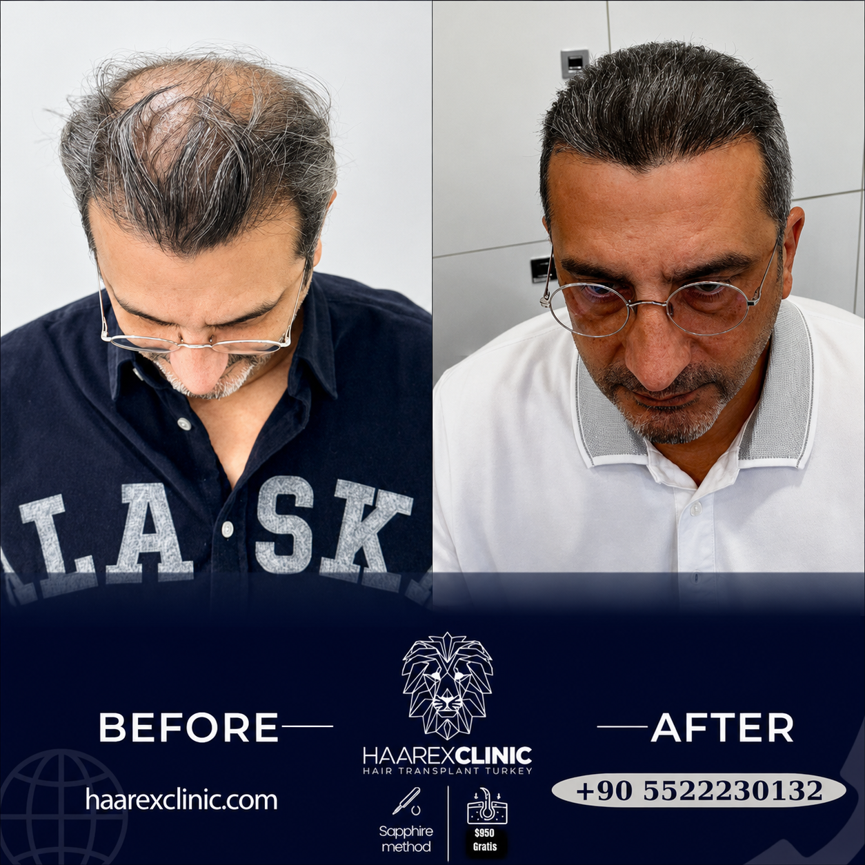 Before After Hair Transplant Result 3