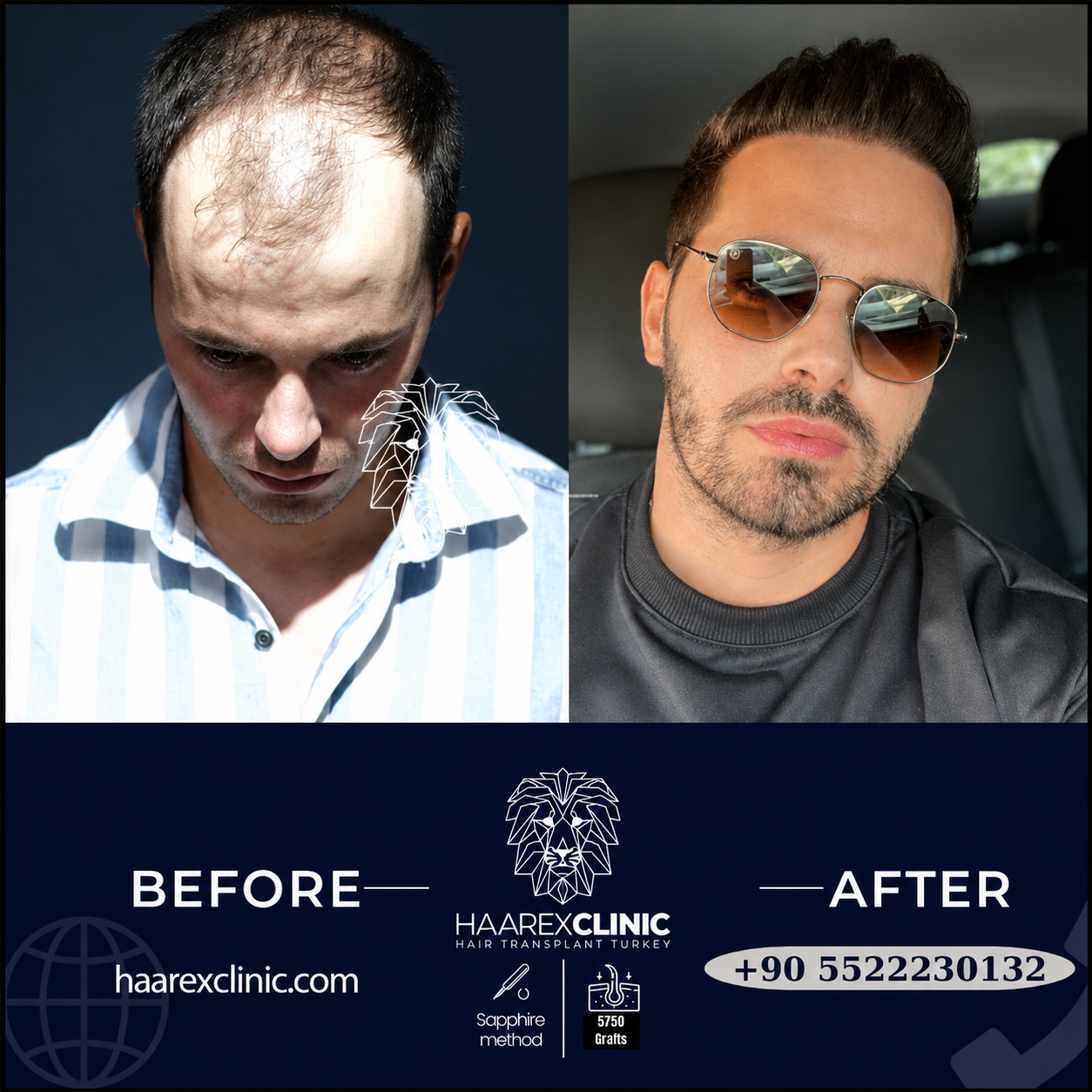 Before After Hair Transplant Result 6