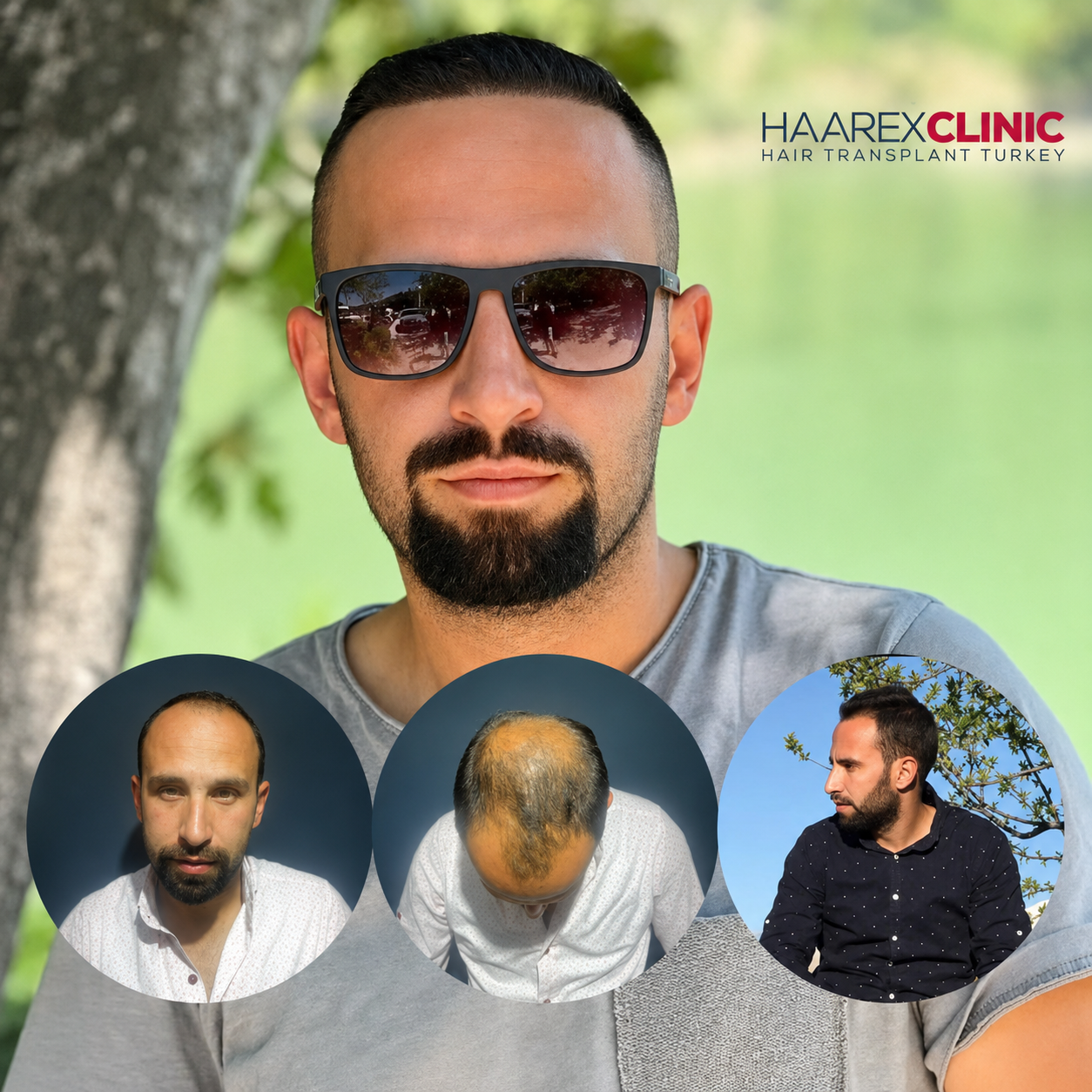 Before After Hair Transplant Result 4