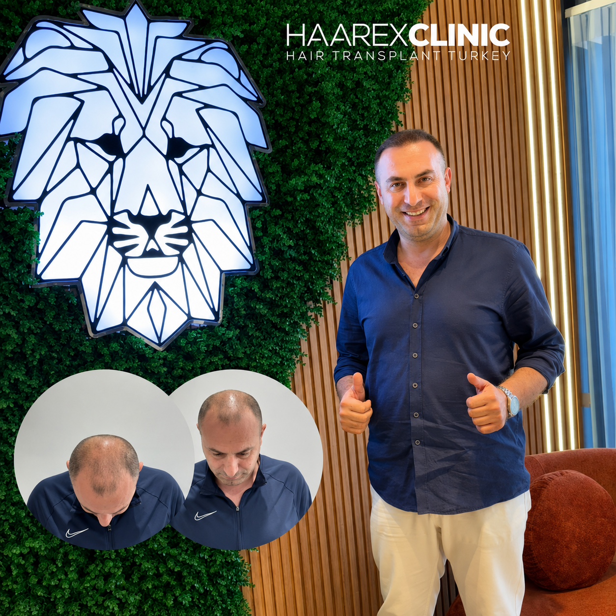 Before After Hair Transplant Result 5