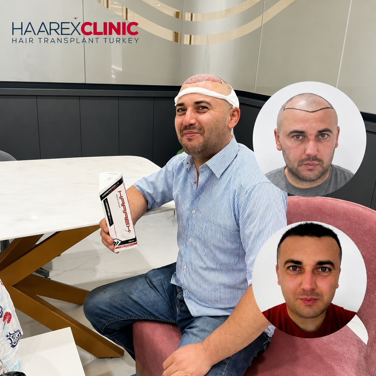 Hair Transplant Before After Results