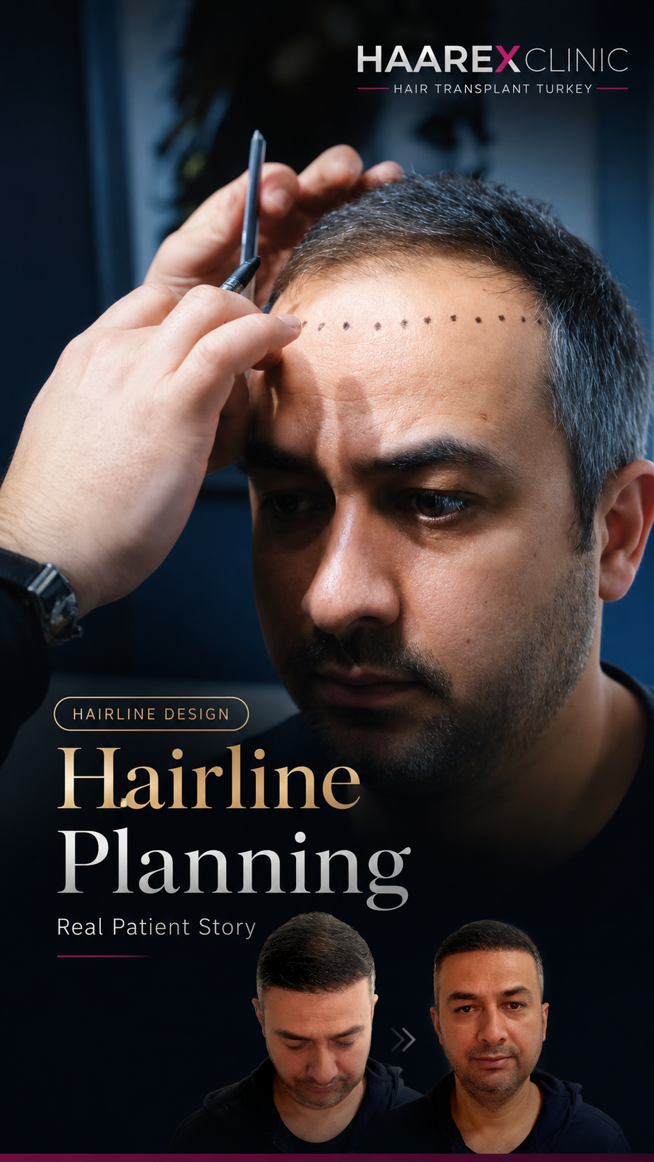 Why choose Haarex Clinic for PRP treatment for hair loss