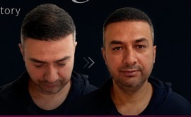 Before After Hair Transplant Result 7