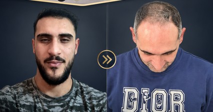 Before After Hair Transplant Result 8