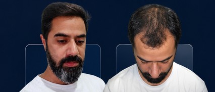 Before After Hair Transplant Result 10