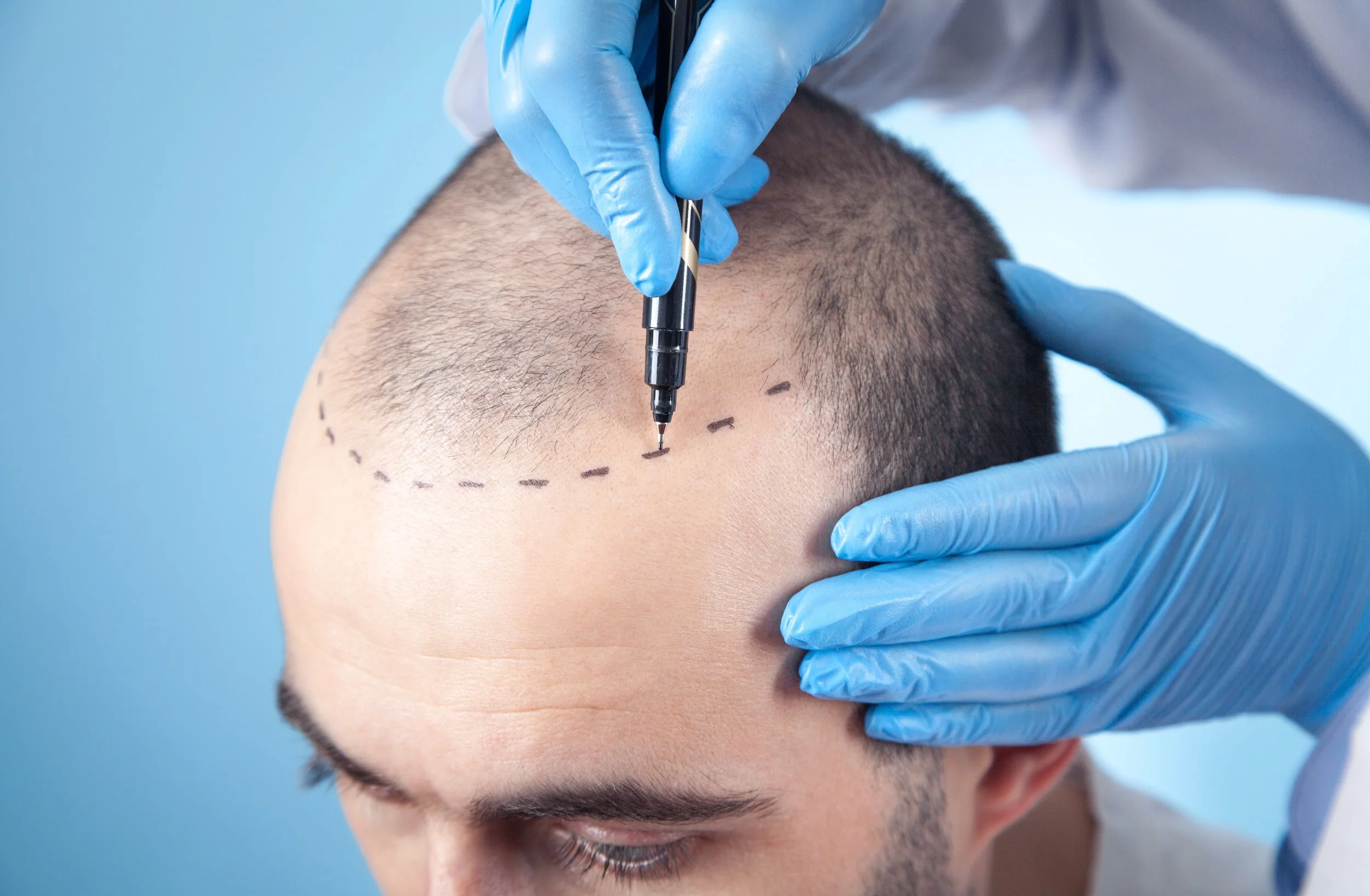 Saphir FUE Haarlinienplanung Antalya