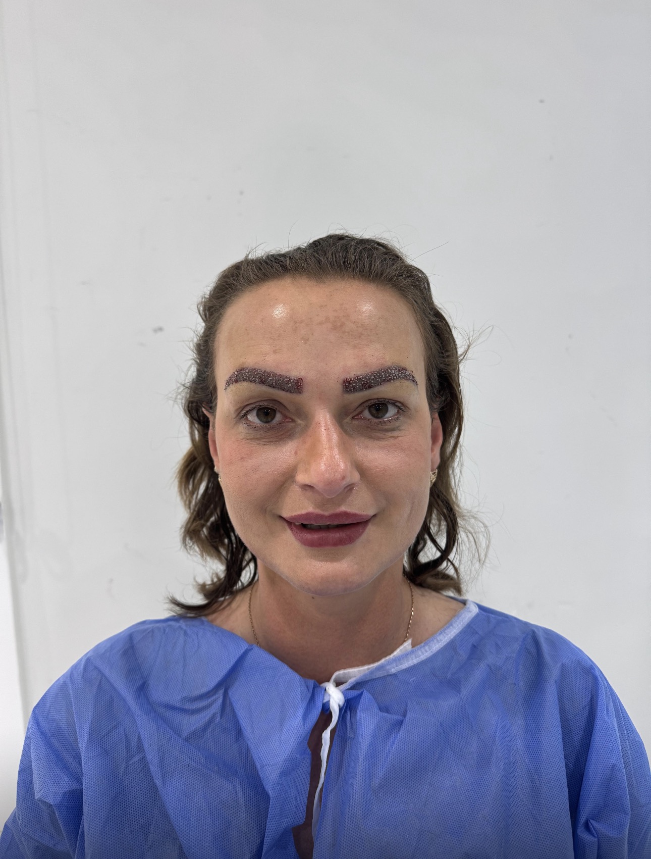 Haarex Clinic eyebrow transplant patient process photo