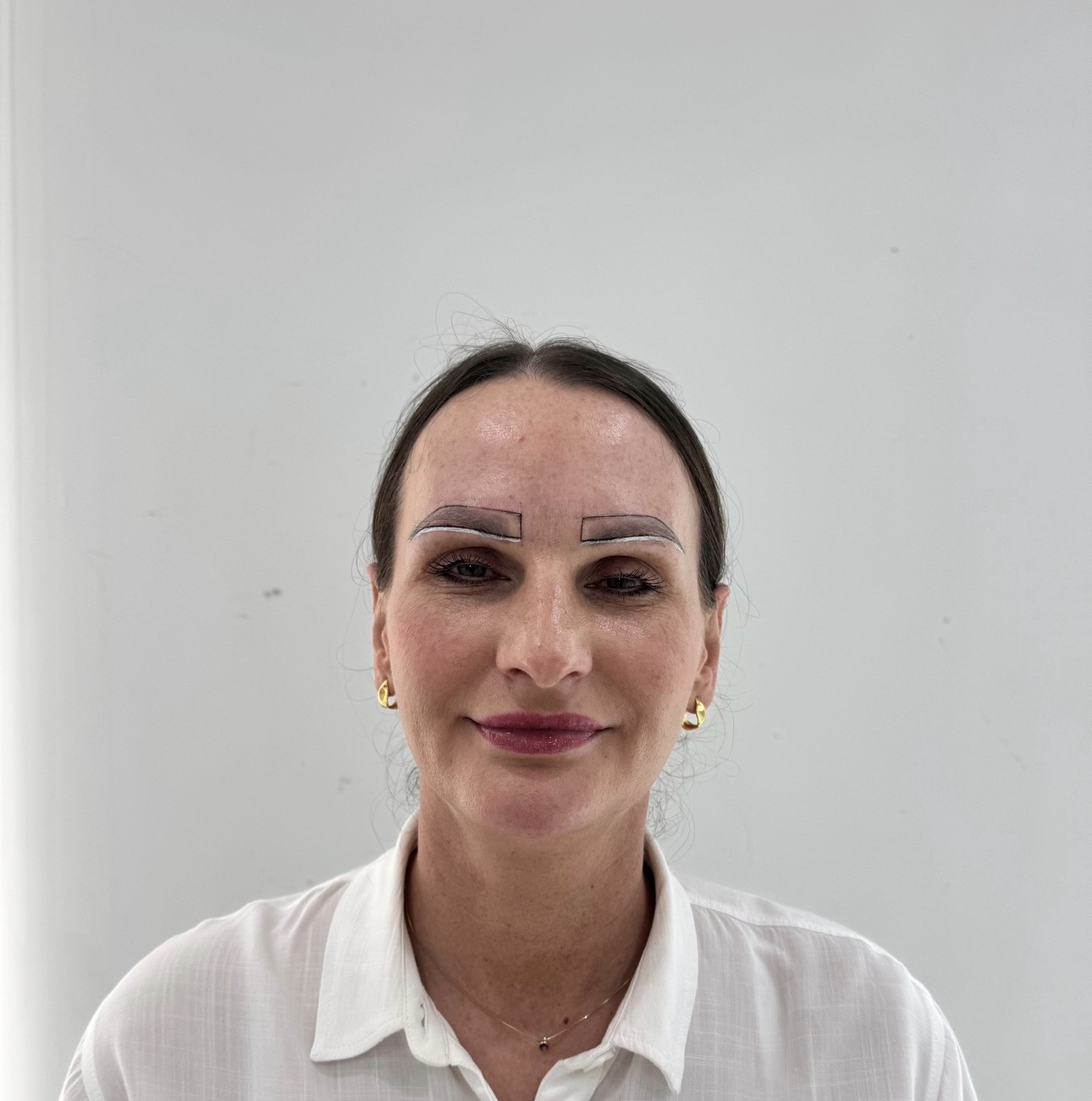 Eyebrow Transplant Antalya Planning