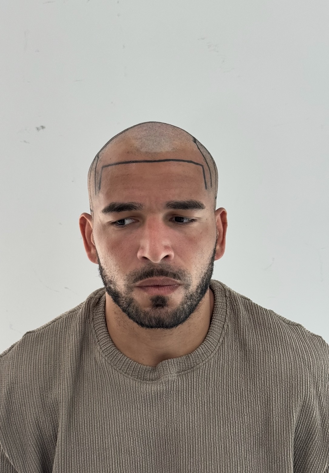 Afro Saç Ekimi Antalya görsel 6