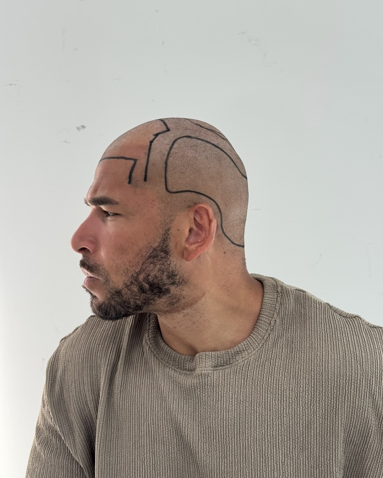 Afro Saç Ekimi Antalya görsel 7