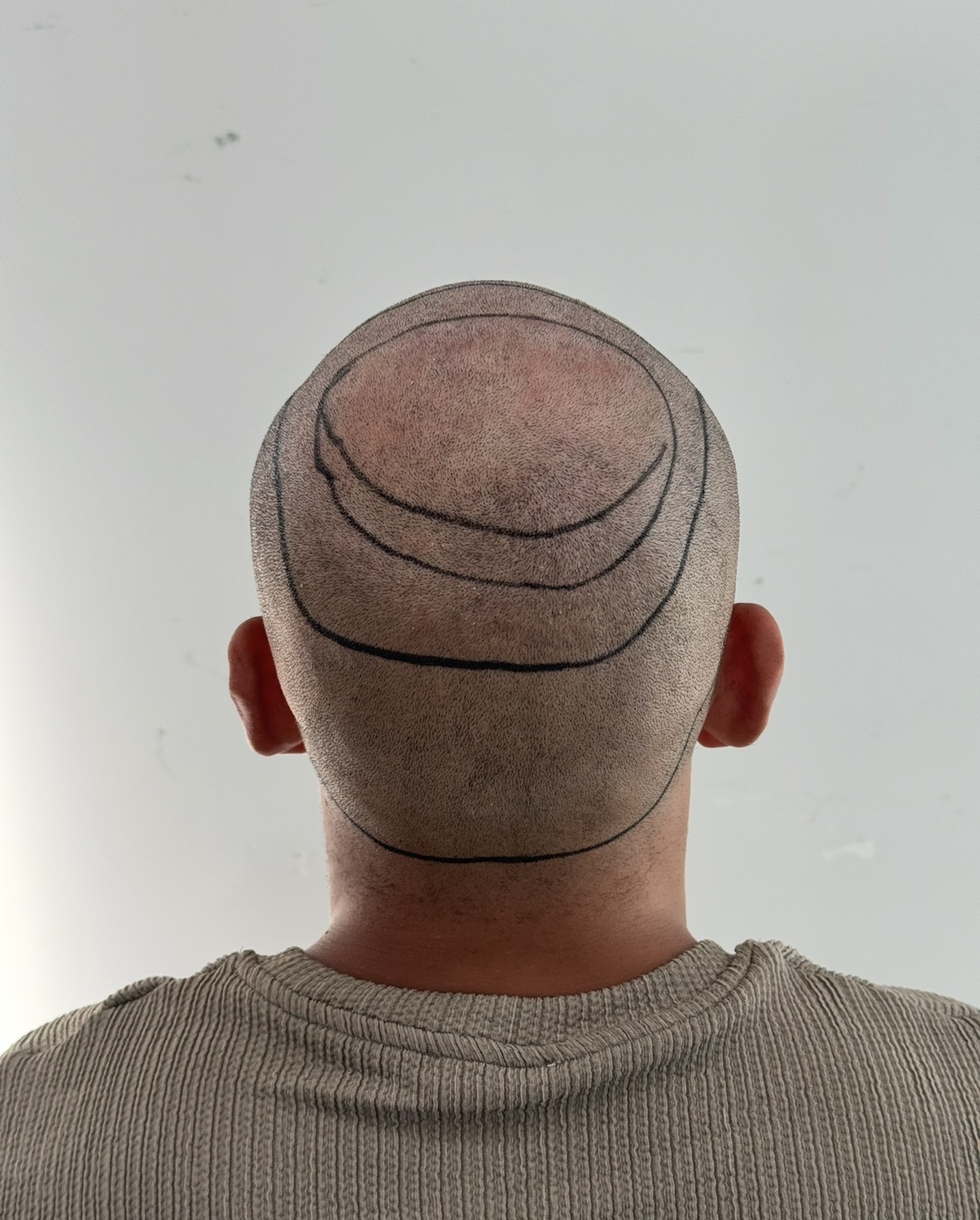 Afro Saç Ekimi Antalya görsel 9