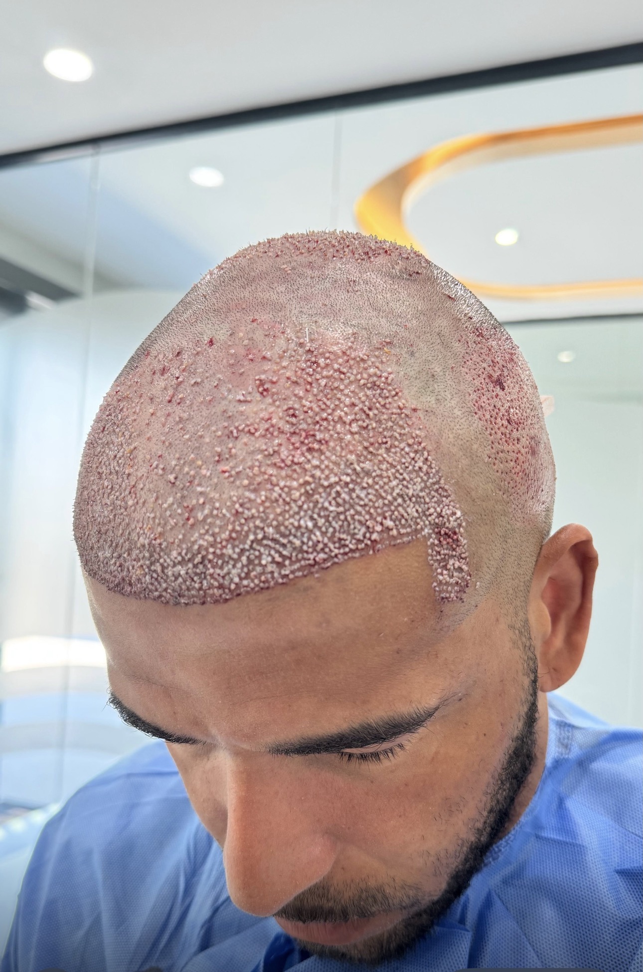 After Hair Transplant Guide