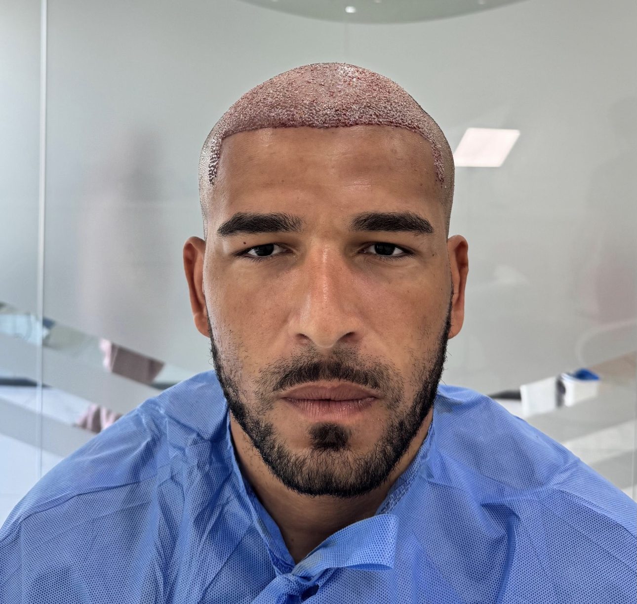 Afro Saç Ekimi Antalya Haarex Clinic