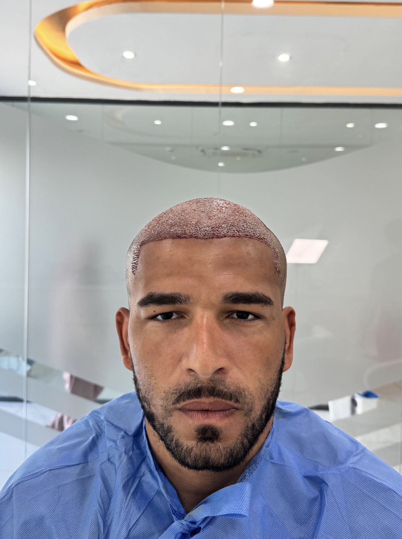 Afro Saç Ekimi Antalya görsel 10