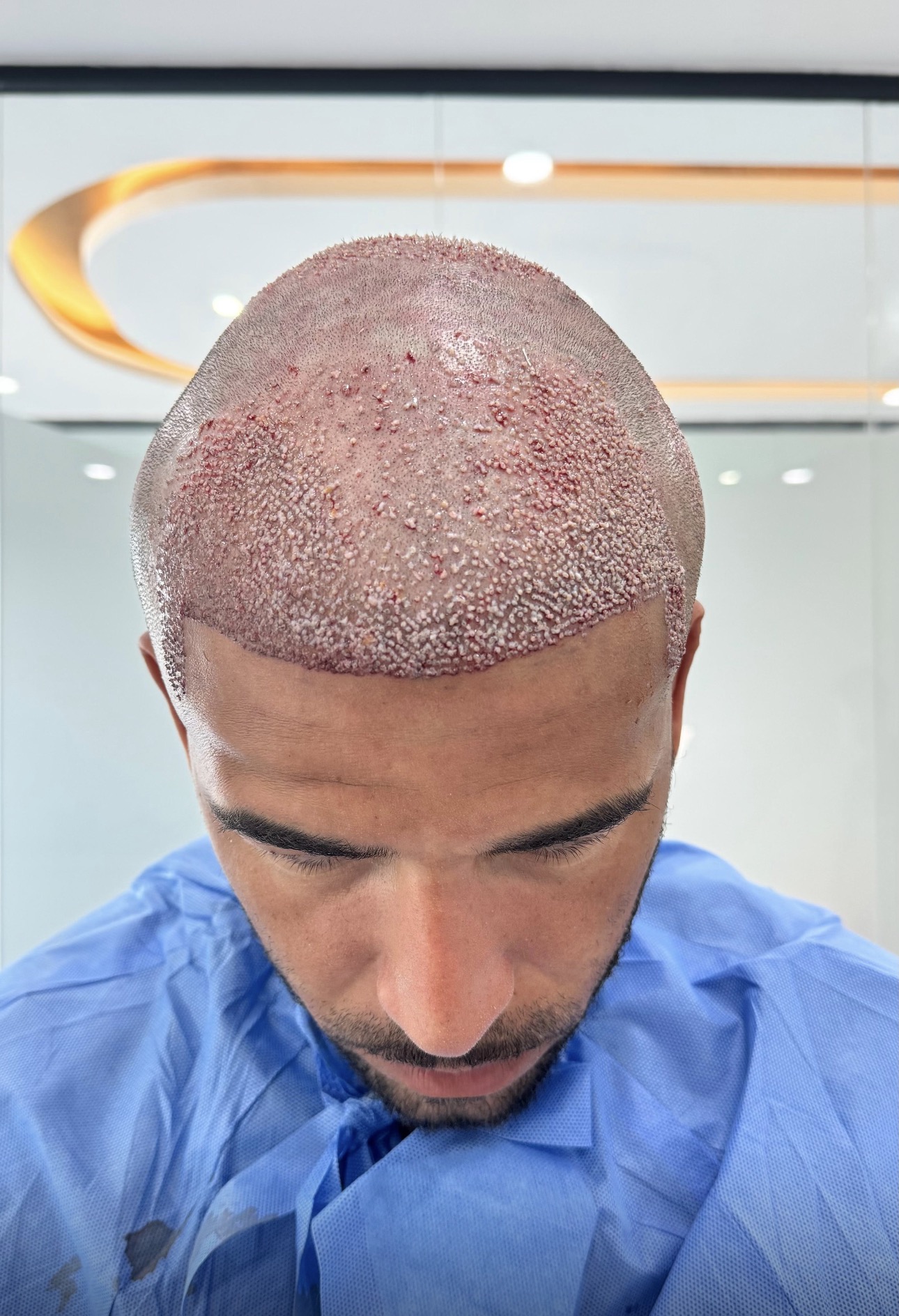 Afro Saç Ekimi Antalya görsel 12