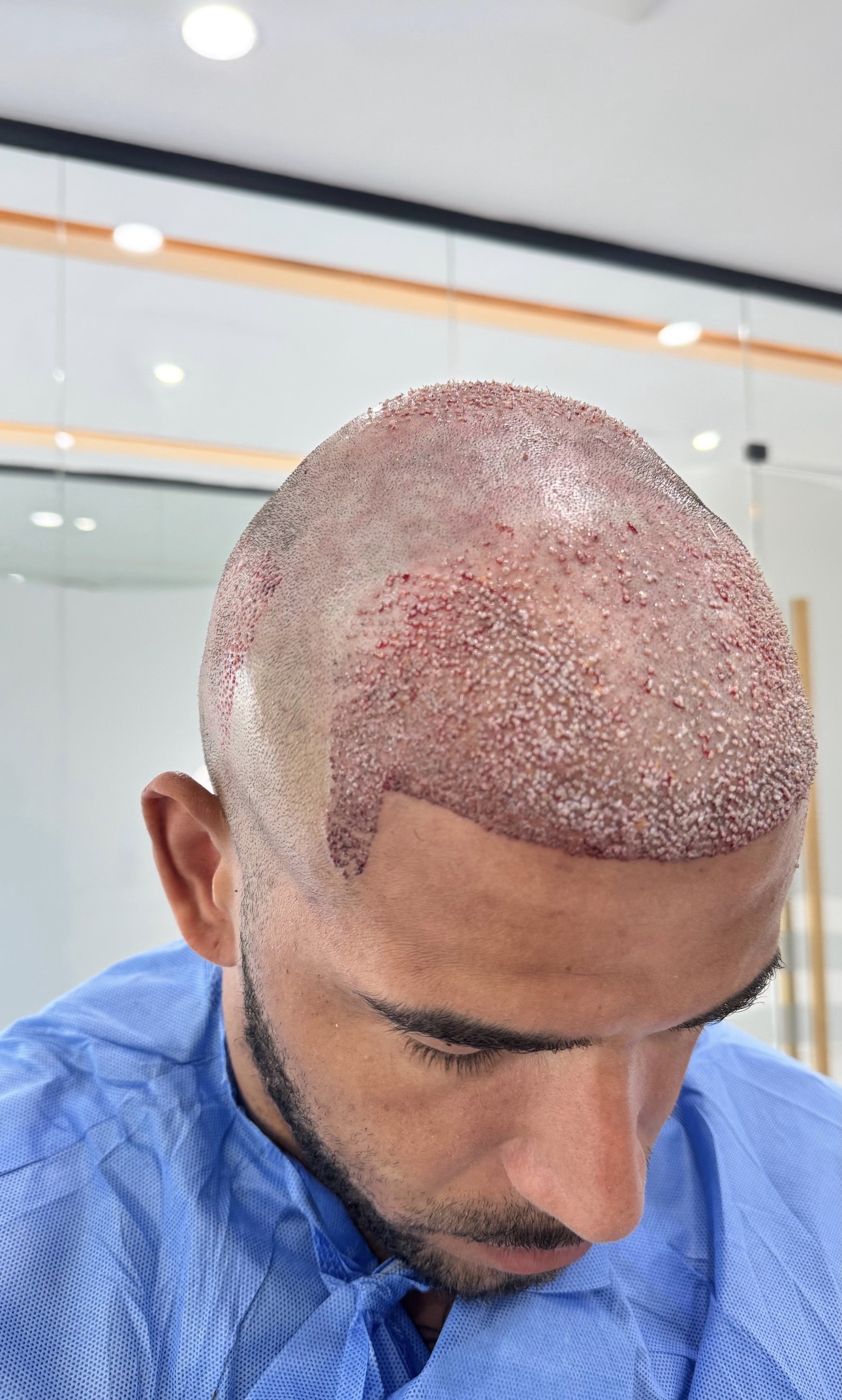 Afro Saç Ekimi Antalya görsel 14