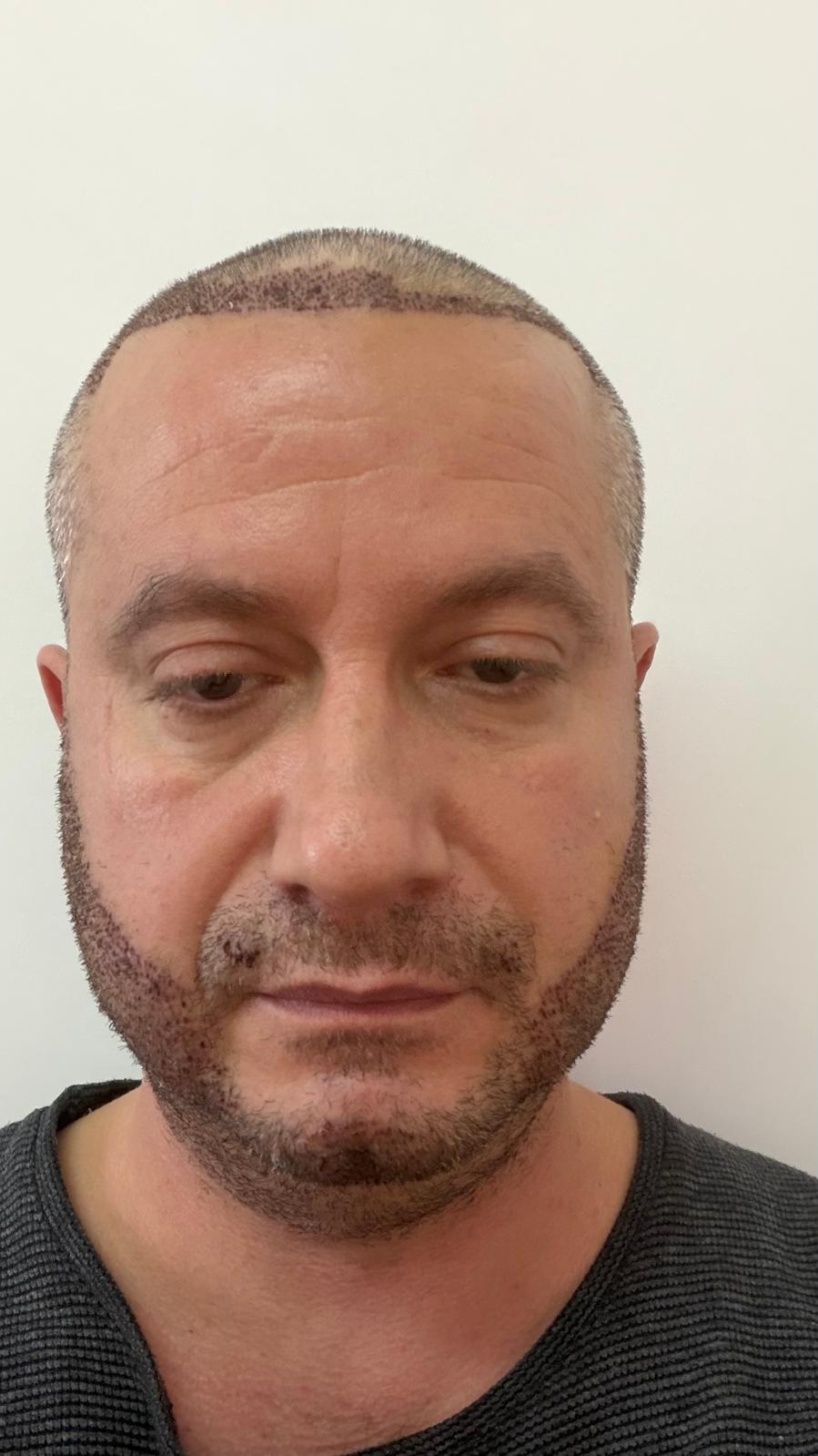 Sakal Nakli Antalya Klinik Görseli 1
