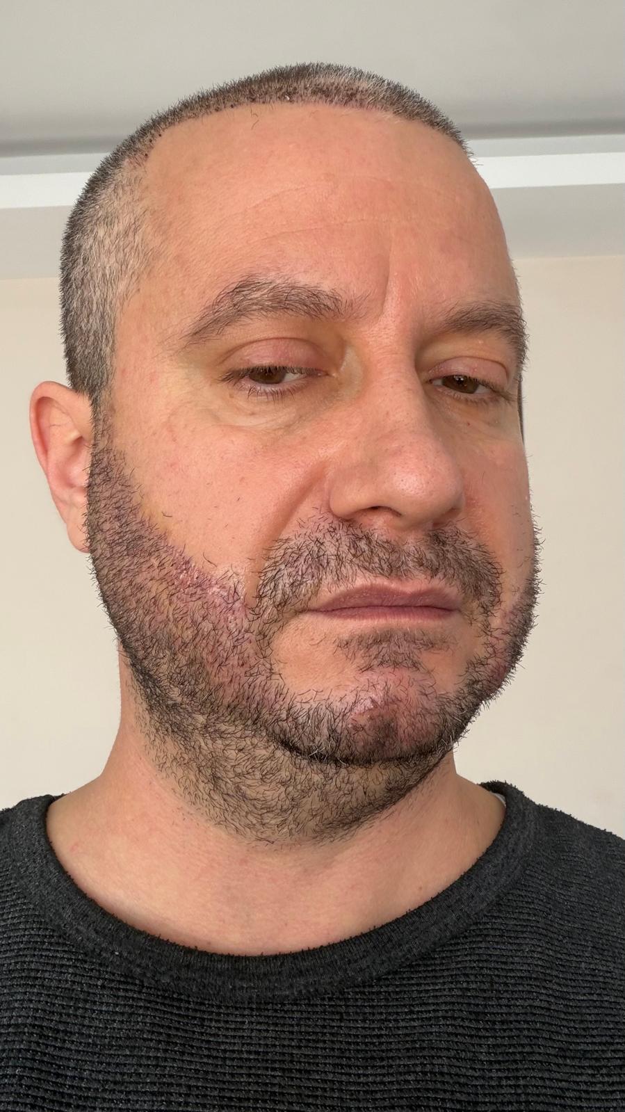 Sakal Nakli Antalya Klinik Görseli 4