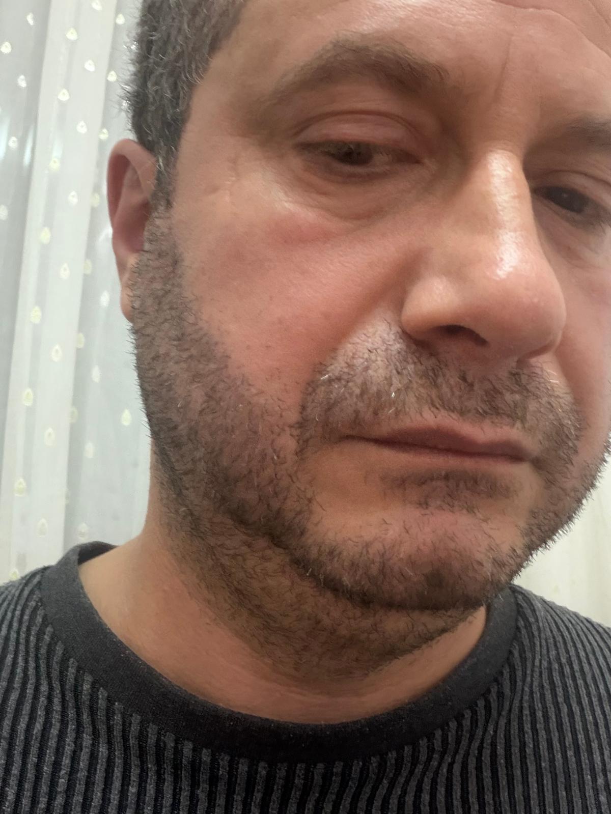 Sakal Nakli Antalya Klinik Görseli 7