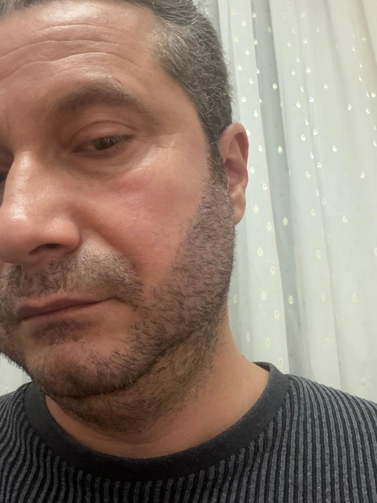 Sakal Nakli Antalya Klinik Görseli 6