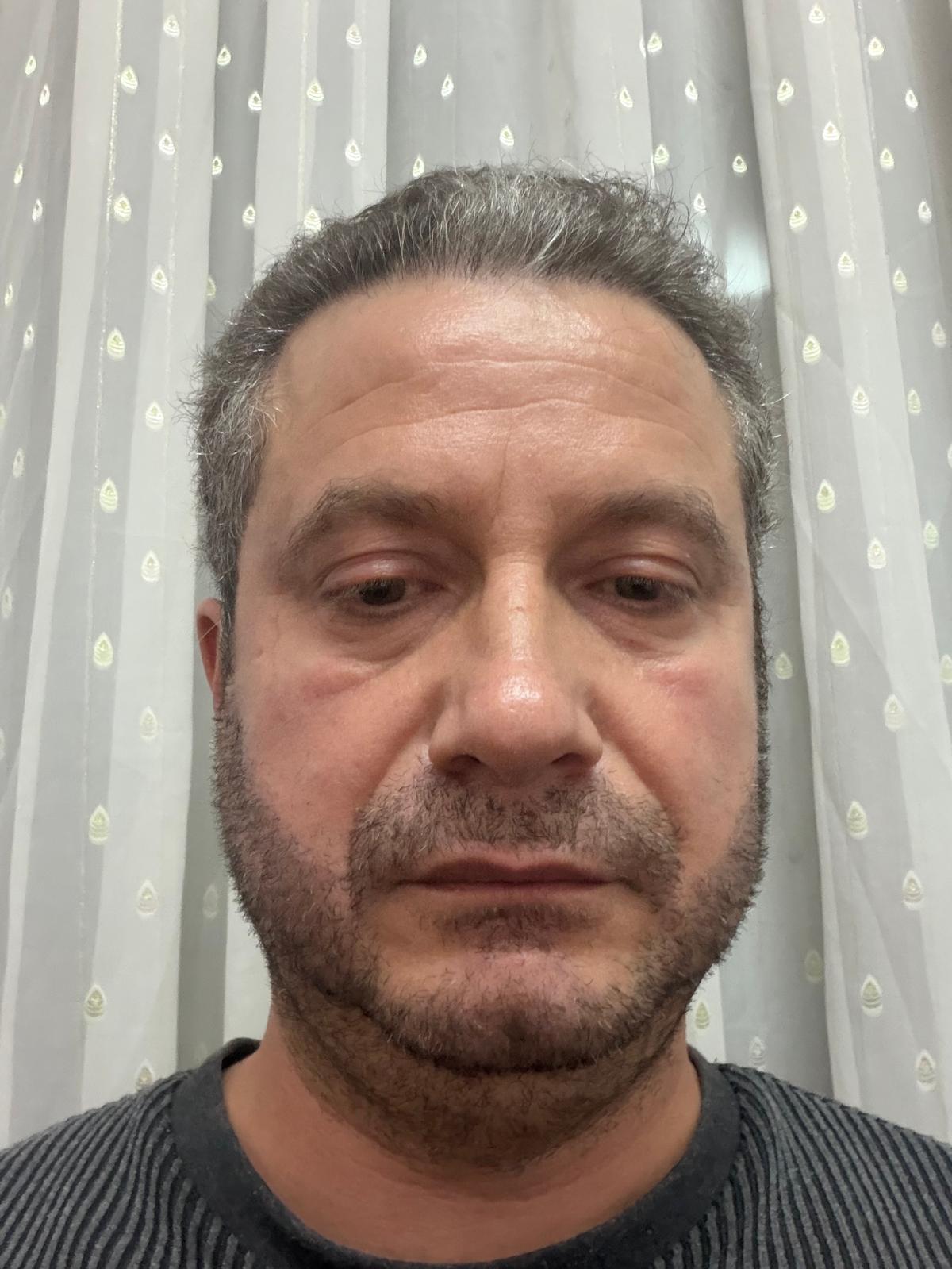 Haarex Clinic Sakal Nakli Antalya Planlaması