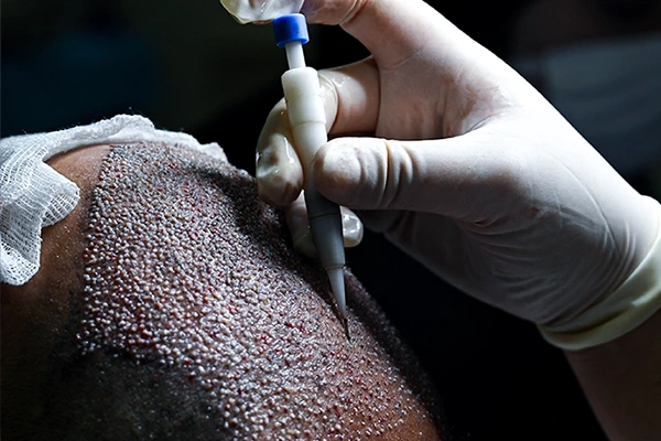 Haarex Clinic DHI Haartransplantation Antalya