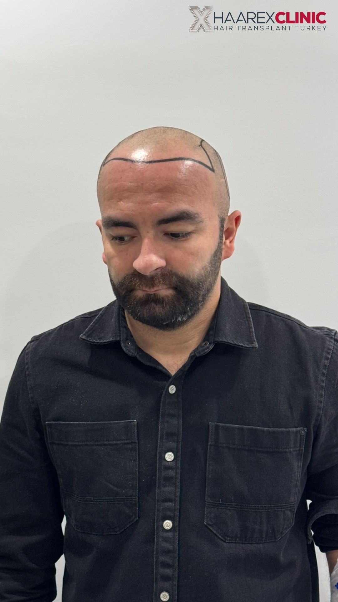 Erkan DHI Haartransplantation vorher