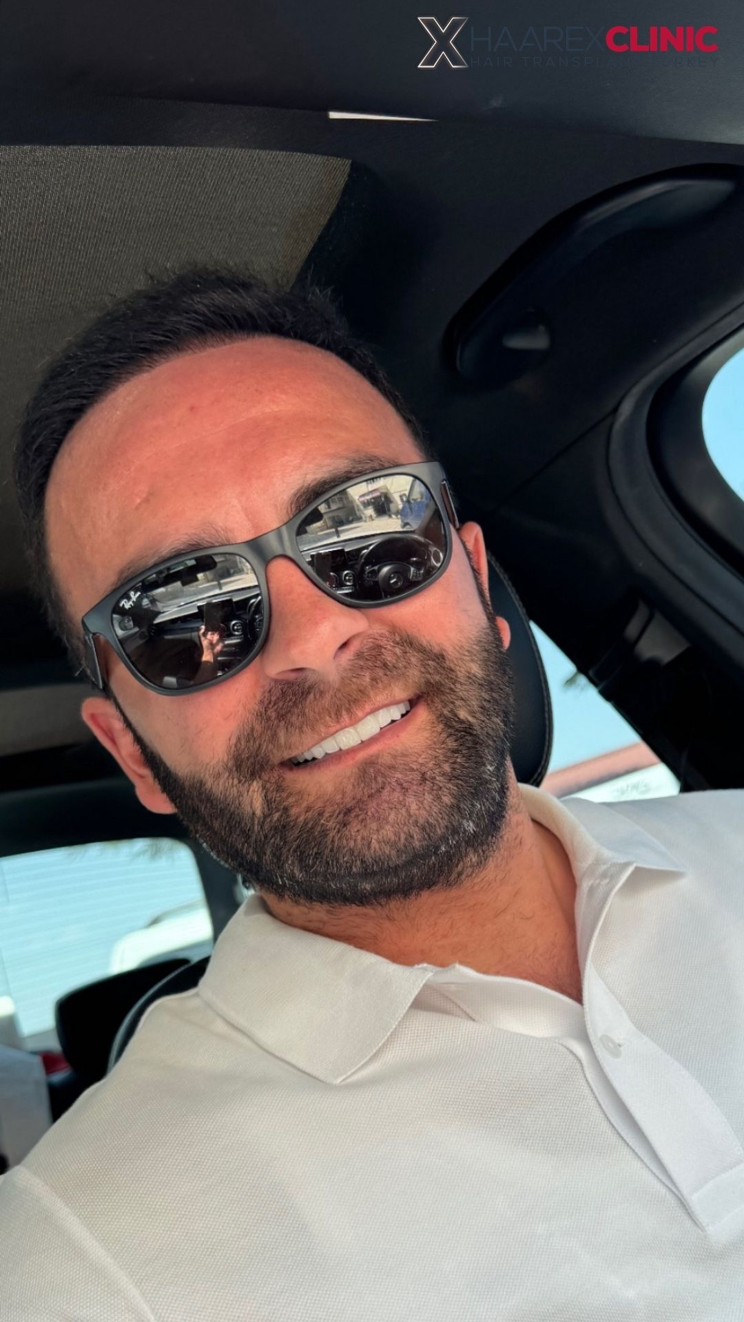 Erkan DHI Haartransplantation nachher