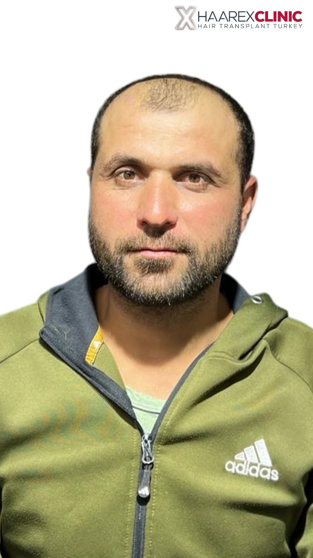 Fazıl Haartransplantation vorher