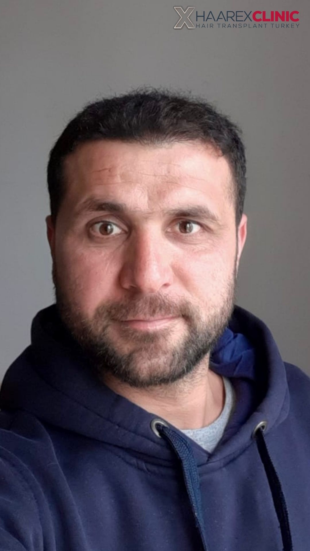 Fazıl Haartransplantation nachher