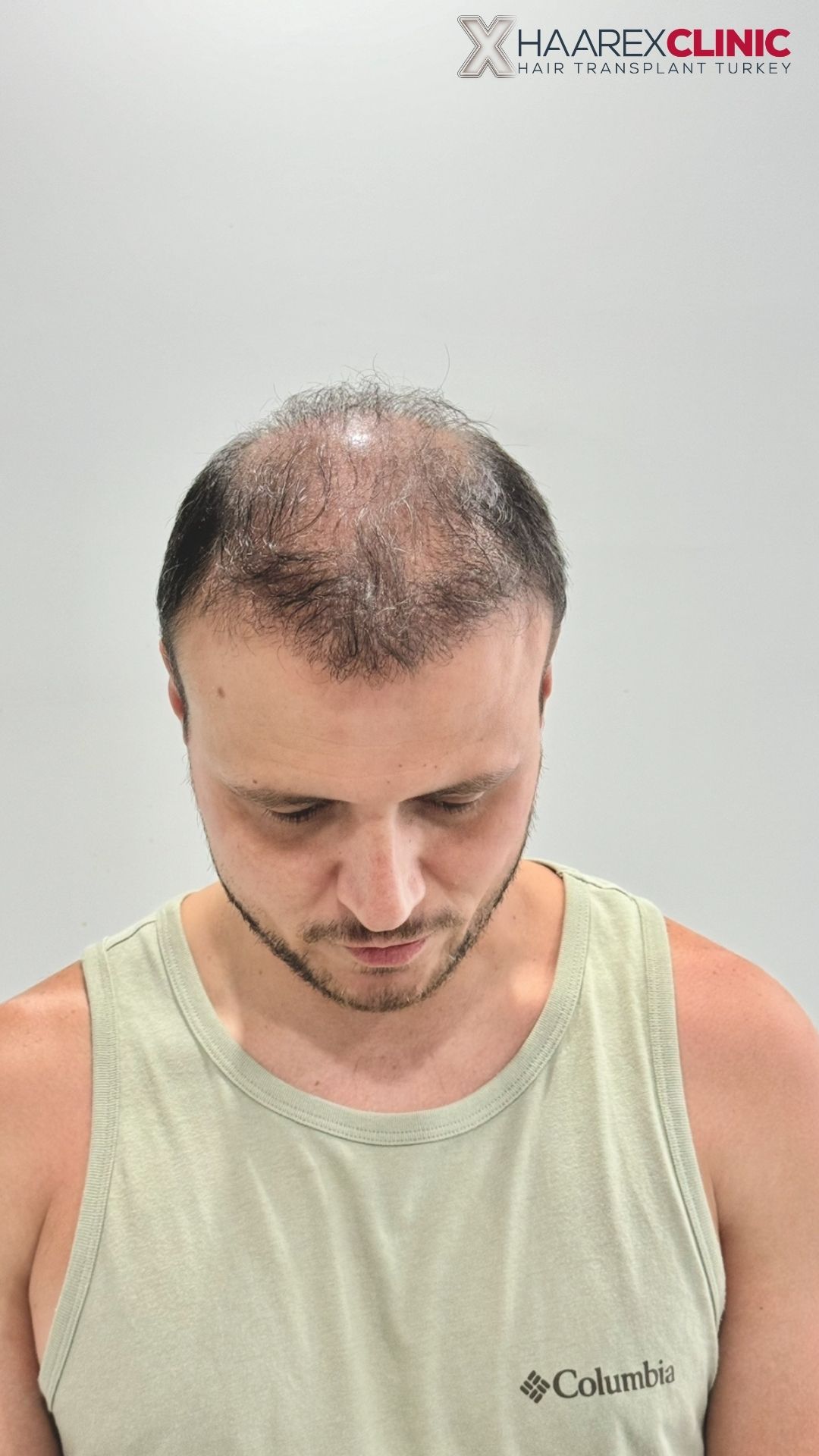 Göktan Al Haartransplantation vorher