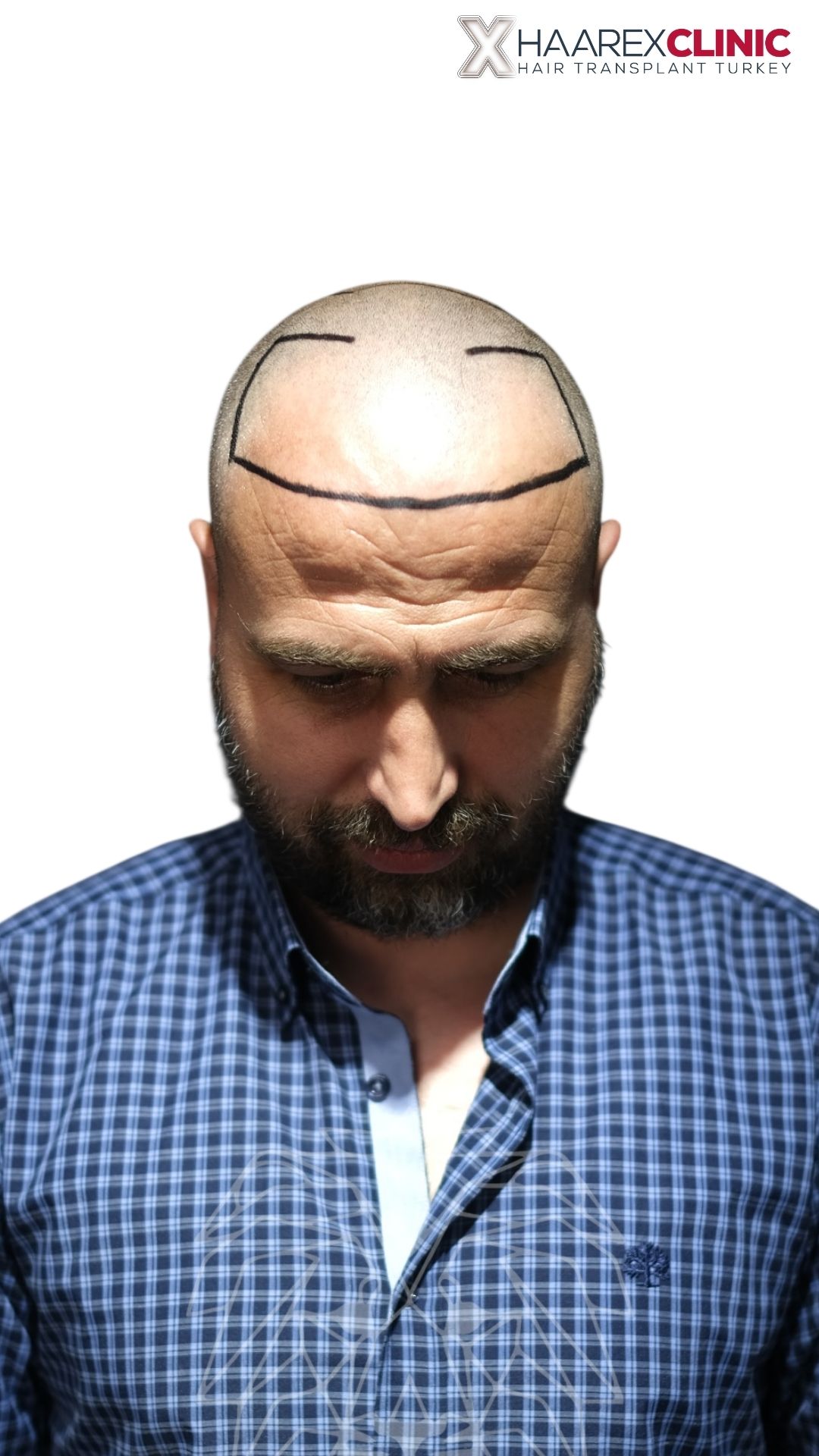 Harun DHI Haartransplantation nachher