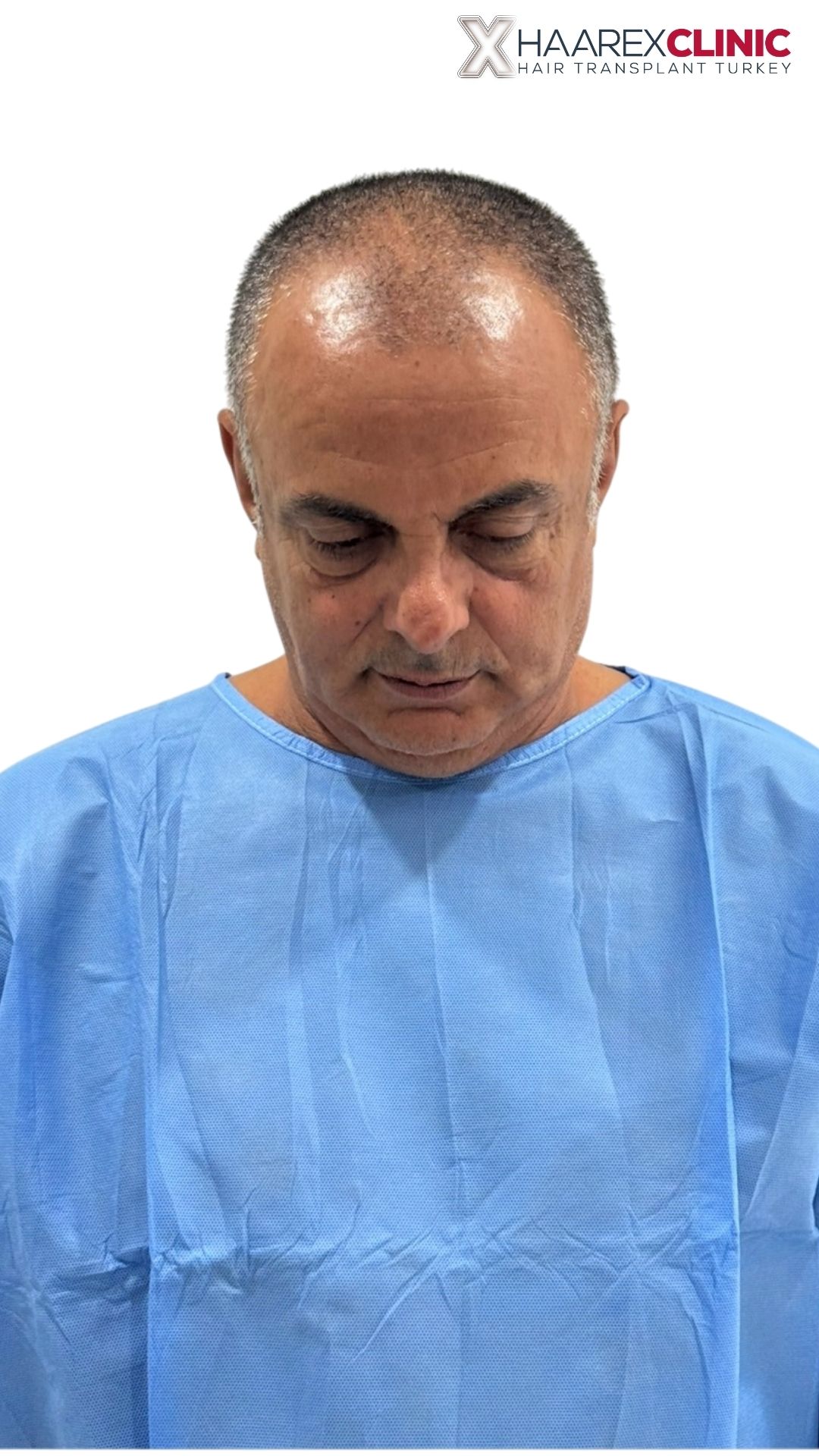 Kenan Haartransplantation vorher