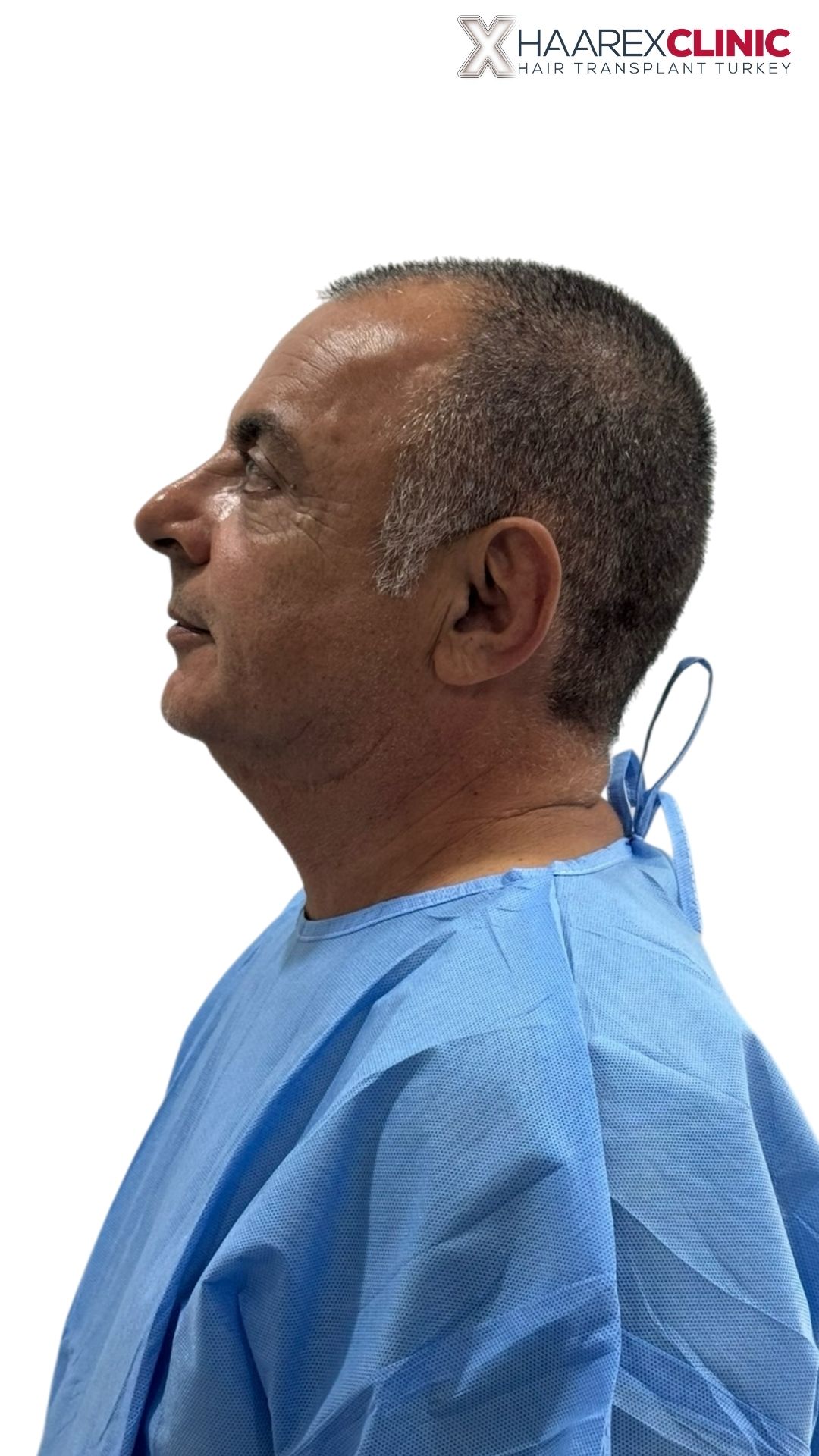 Natürliches Haartransplantationsergebnis geplant von Haarex Clinic
