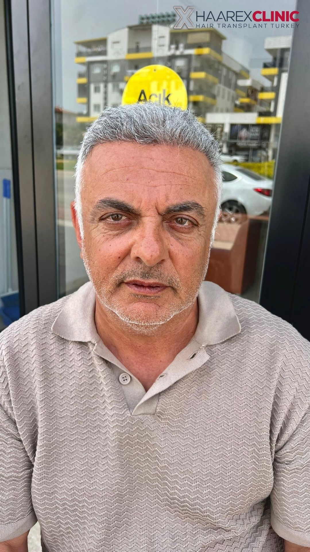Kenan Haartransplantation nachher