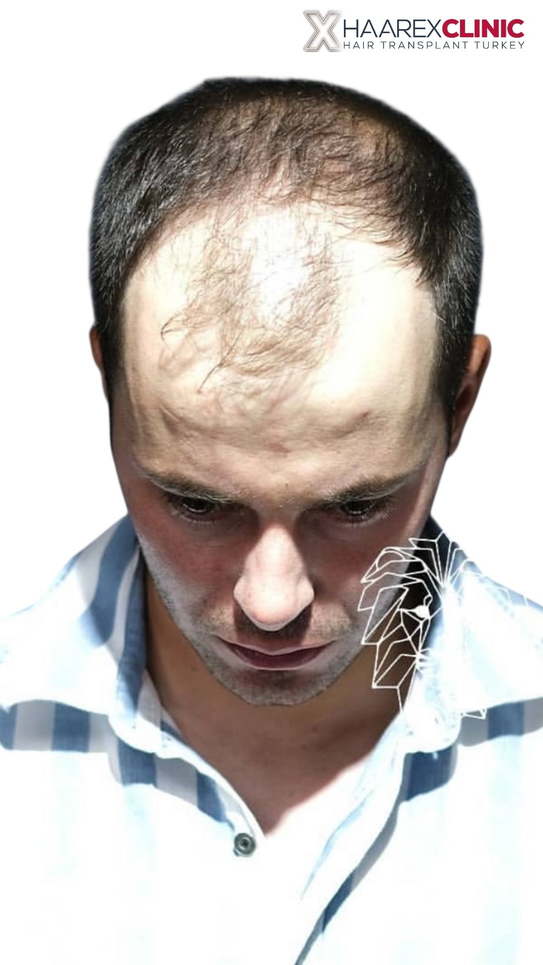 Haartransplantation Vorher Vergleichsfoto