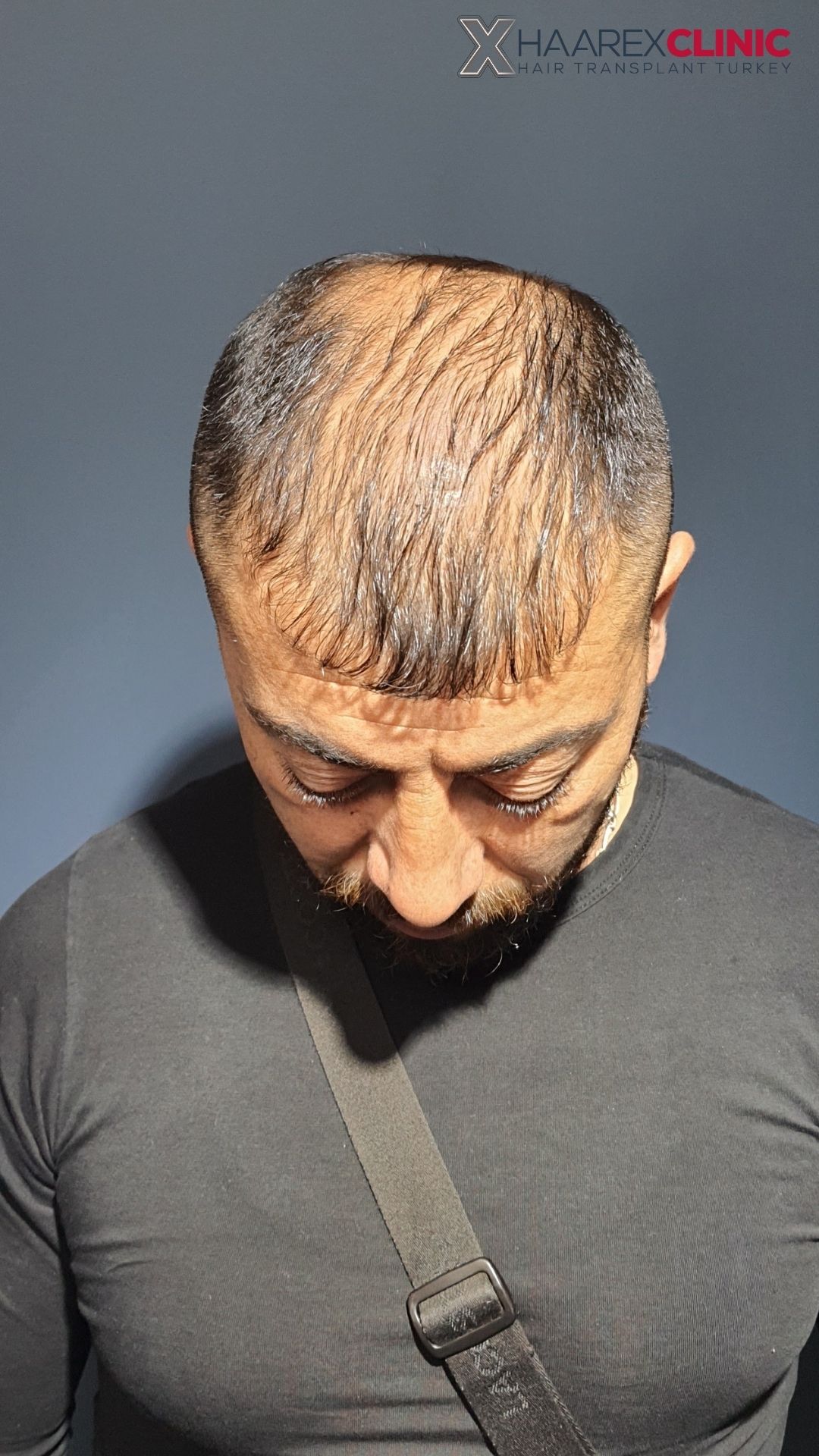 Haartransplantation Vorher Ansicht