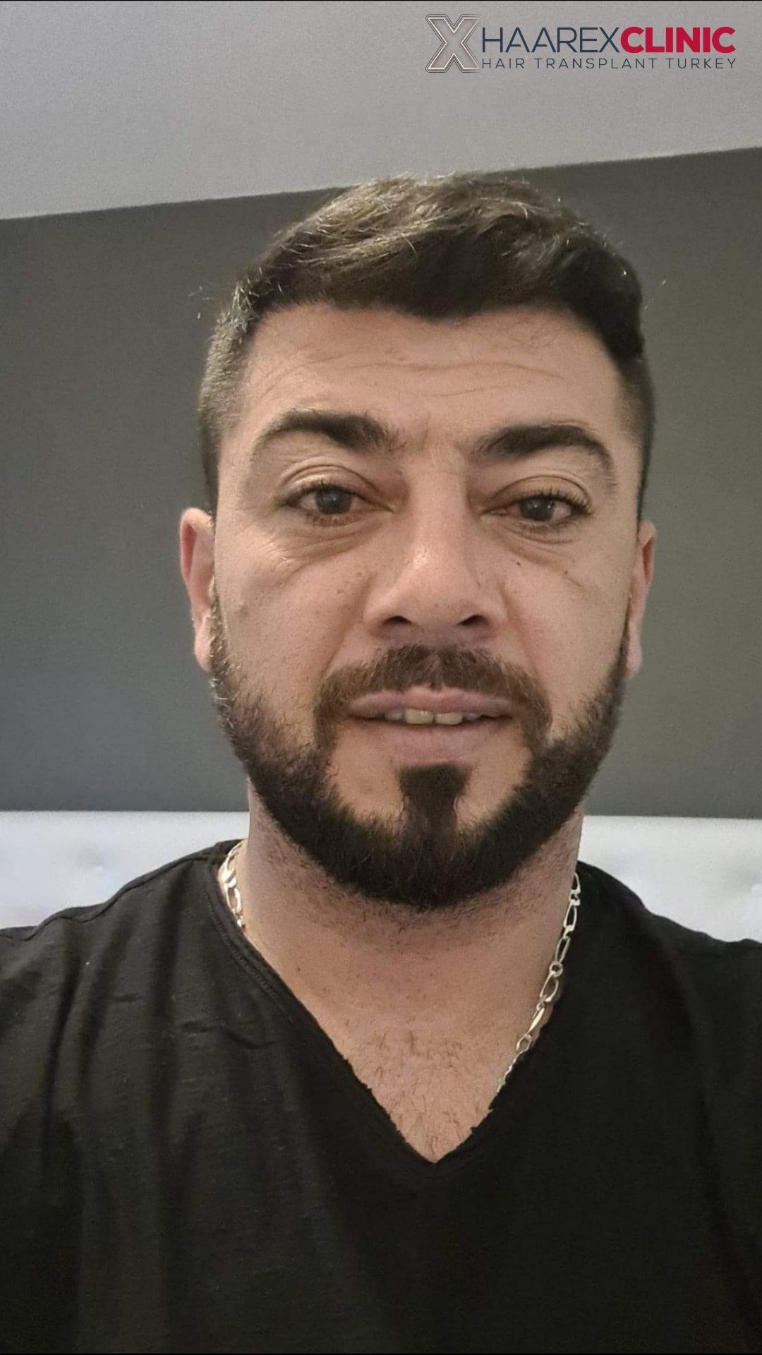 Metin Haartransplantation nachher
