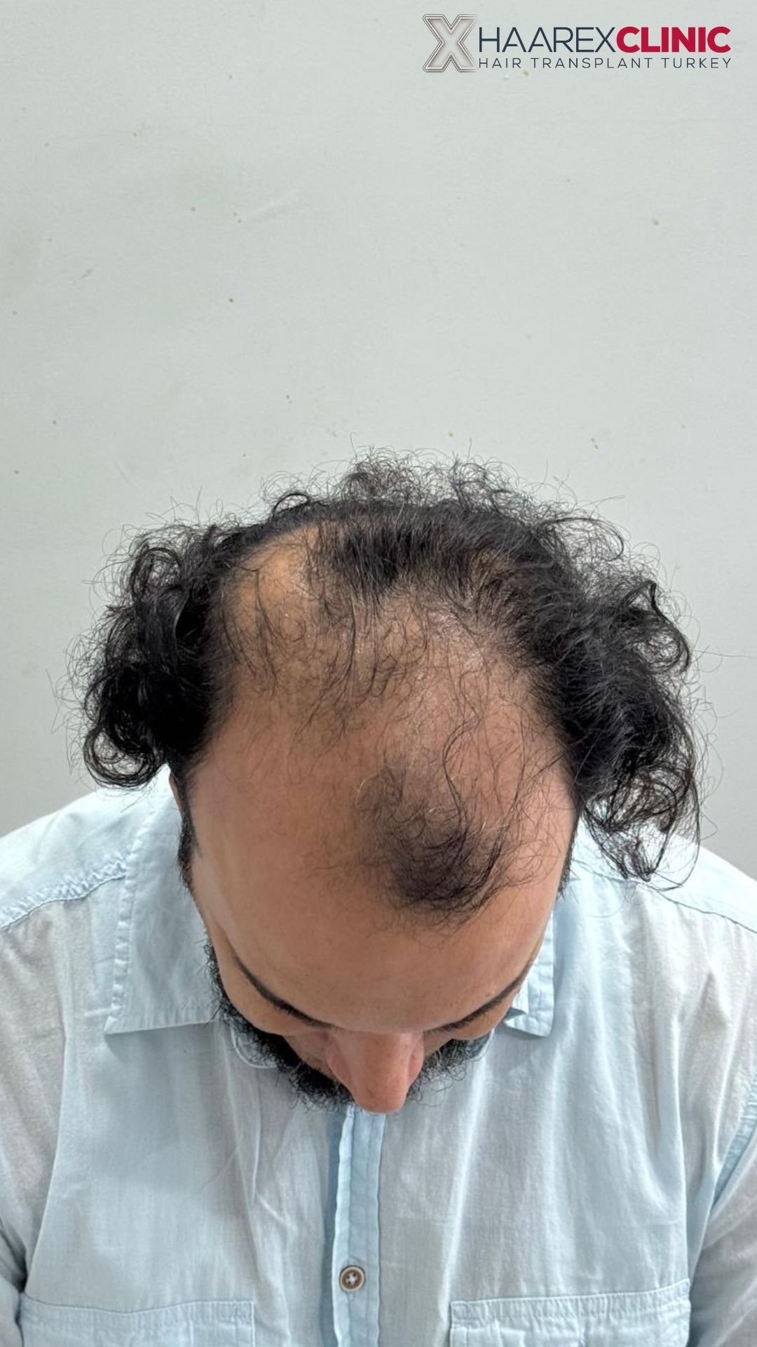 Ratgeber vor der Haartransplantation